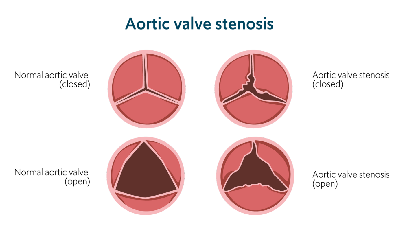 Illustration of aortic valve stenosis showing a normal and closed heart valve