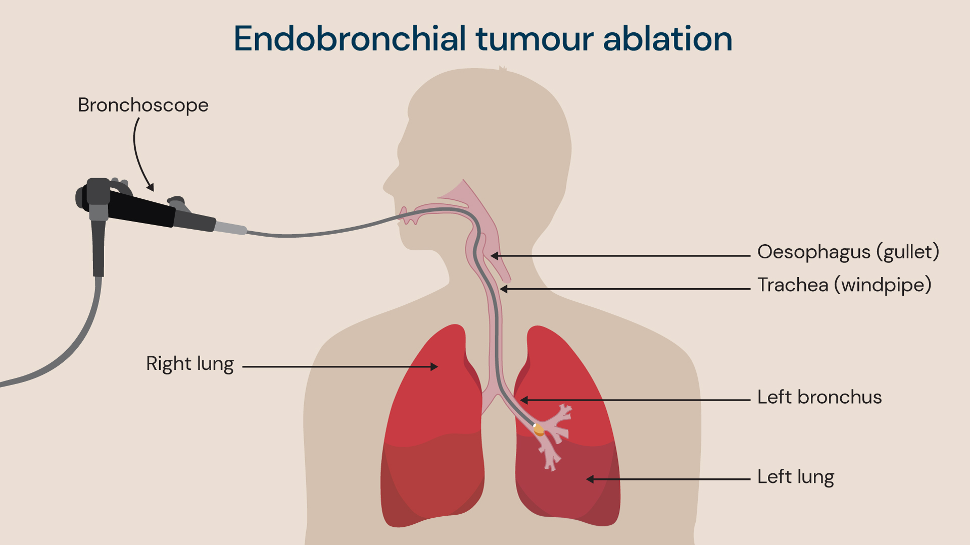 A visual of the endobronchial cryotherapy procedure.