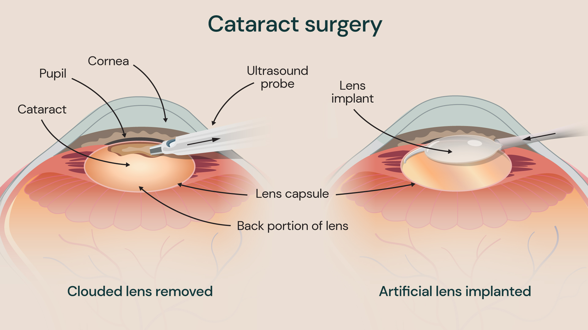 Medical illustration showing cataract surgery, with a clouded natural lens removed using an ultrasound probe and an artificial lens implanted inside the eye, labelled to show the cornea, pupil and lens capsule.