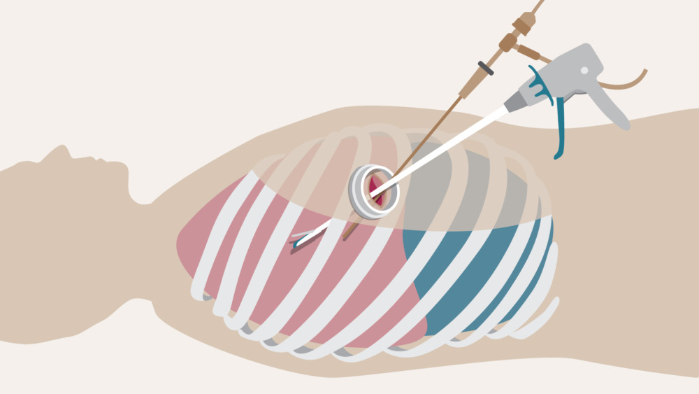 A visual of the single-port VATS procedure.