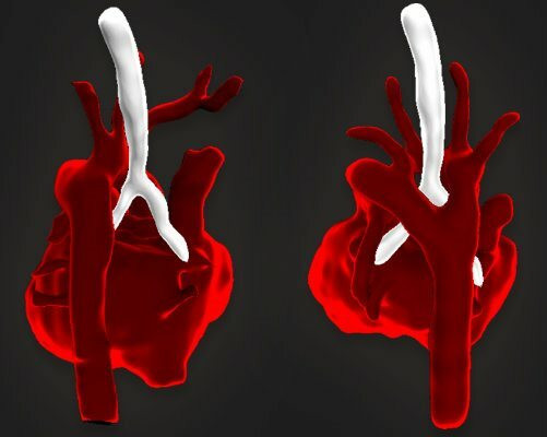 Three‑dimensional medical illustration showing two views of a fetal heart with major blood vessels highlighted against a dark background.