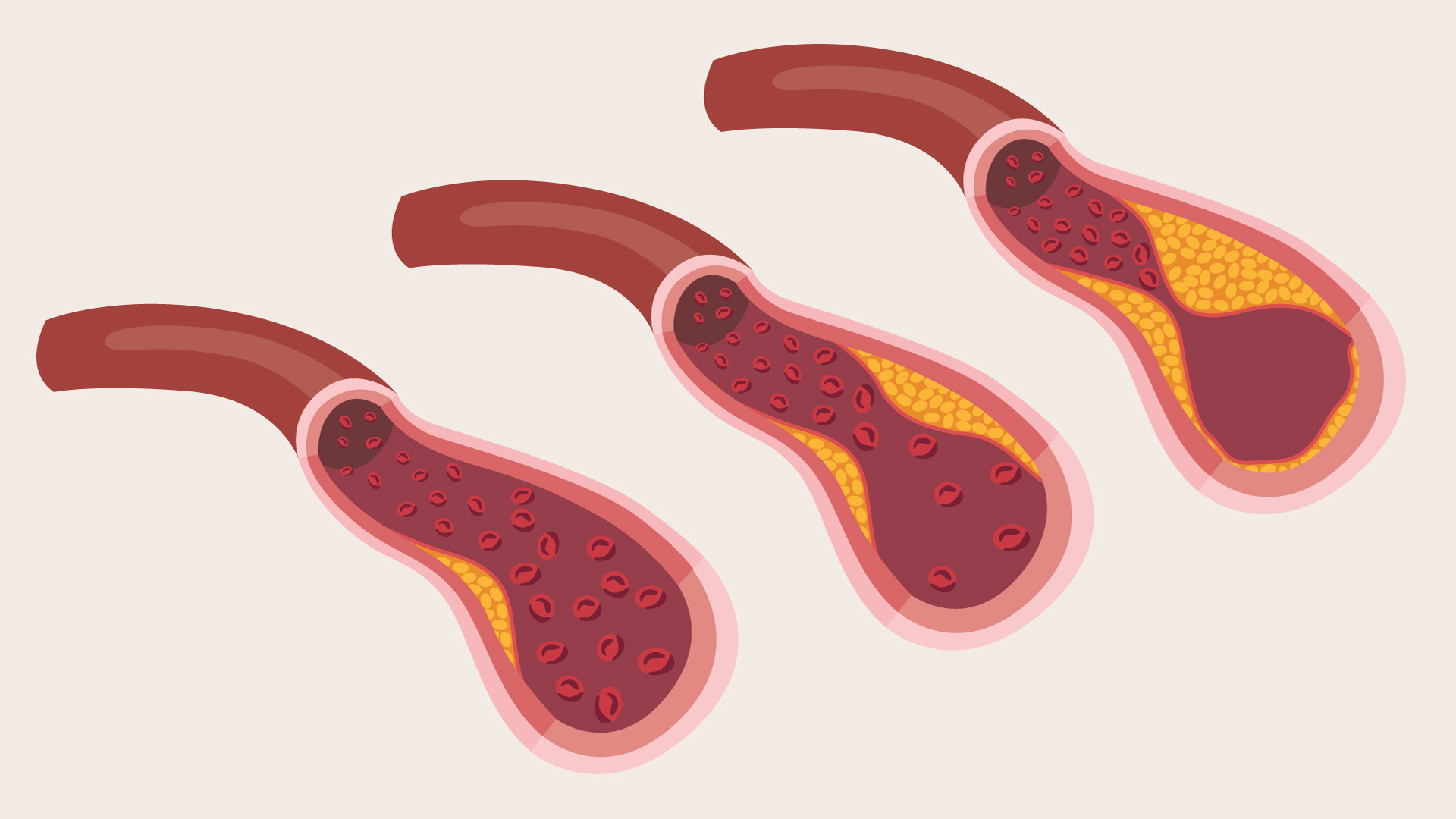 Illustration showing three coronary arteries supplying blood to the heart, ranging from healthy to narrowed, to demonstrate the progression of coronary heart disease.