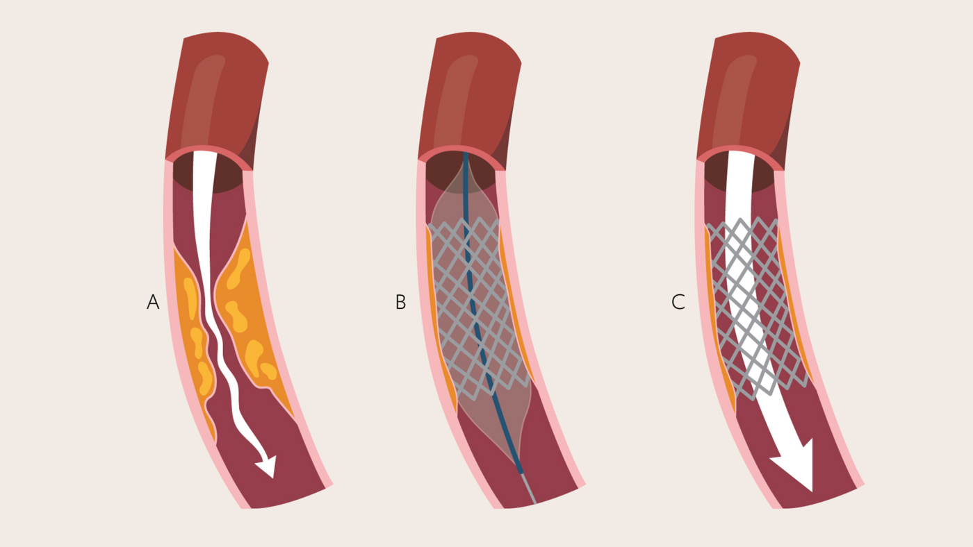 Illustration showing a heart artery before treatment, during stent placement, and after blood flow is improved.