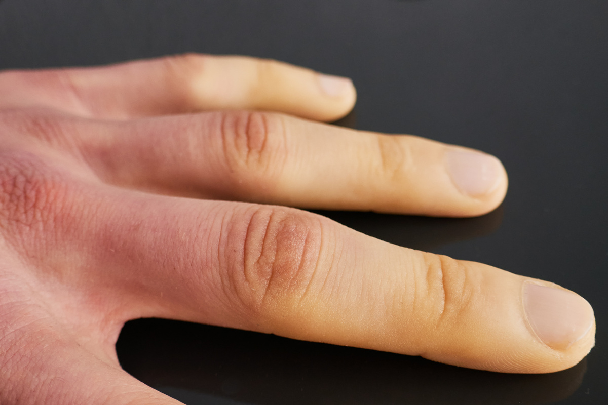 White fingers from the cold, poor blood circulation close up