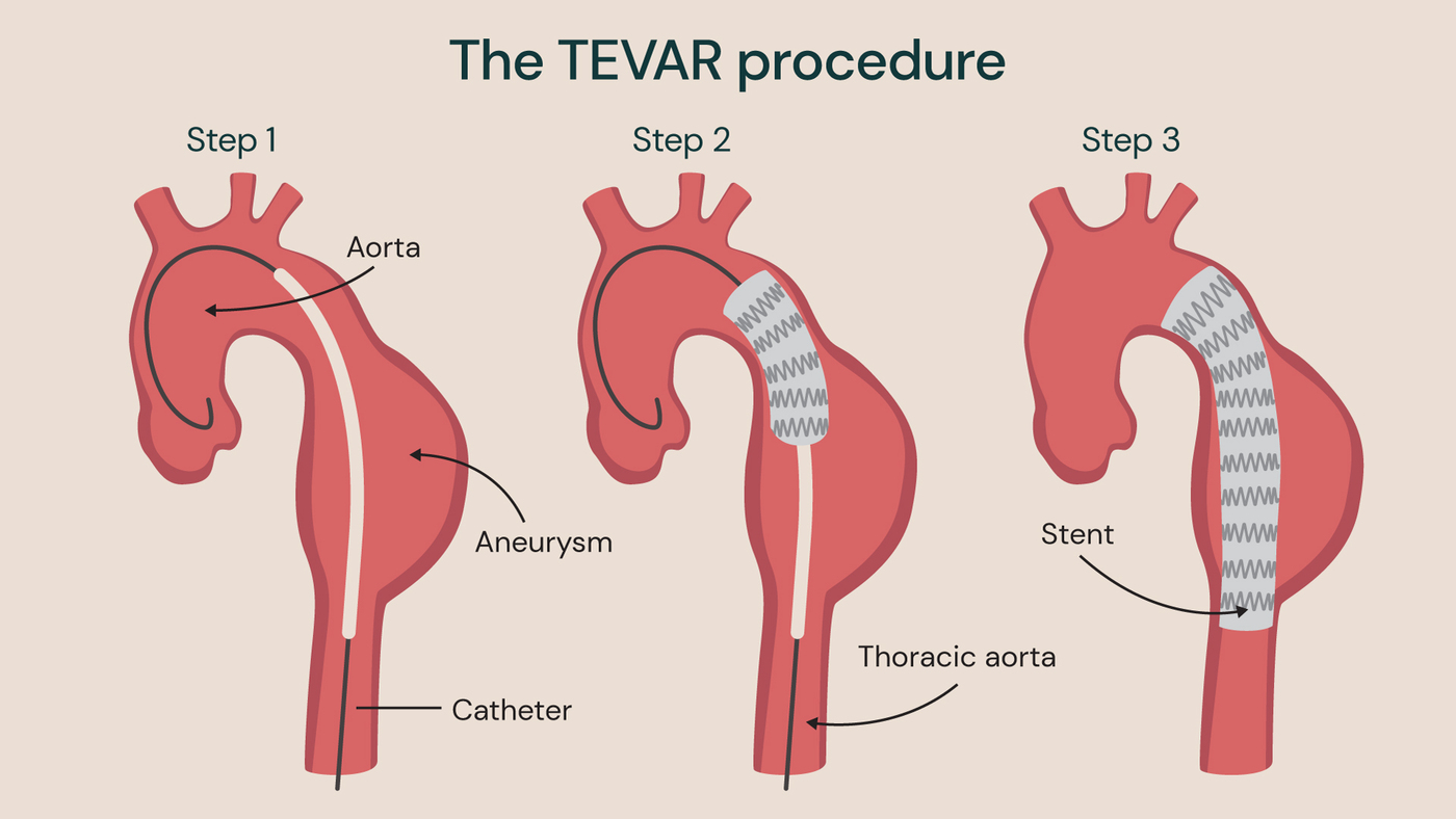 Three‑step diagram of TEVAR showing a stent graft inserted into the descending aorta to treat an aortic aneurysm.