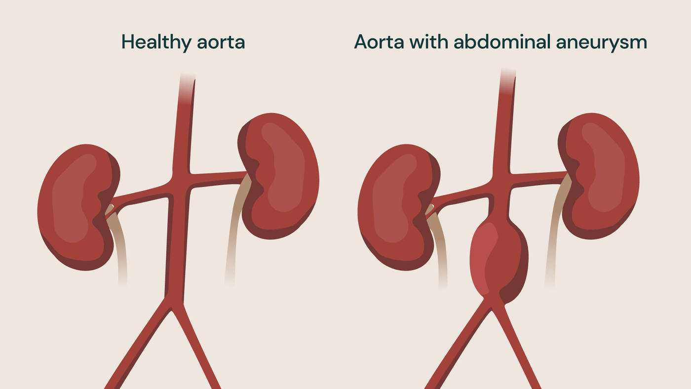 Illustration comparing a healthy aorta with an abdominal aortic aneurysm, showing a widened section of the artery.