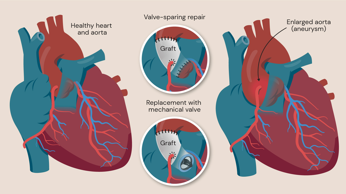 Diagram showing aortic root aneurysm repair with two options: valve replacement using a prosthetic valve and valve‑sparing David procedure when the aortic valve is healthy.