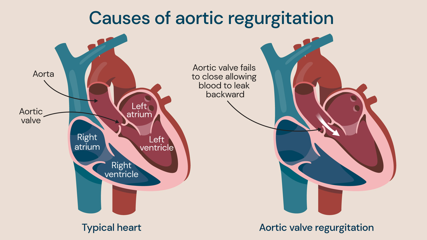 Diagram comparing a typical heart with aortic valve regurgitation, showing the aortic valve failing to close properly and allowing blood to leak backward into the left ventricle.