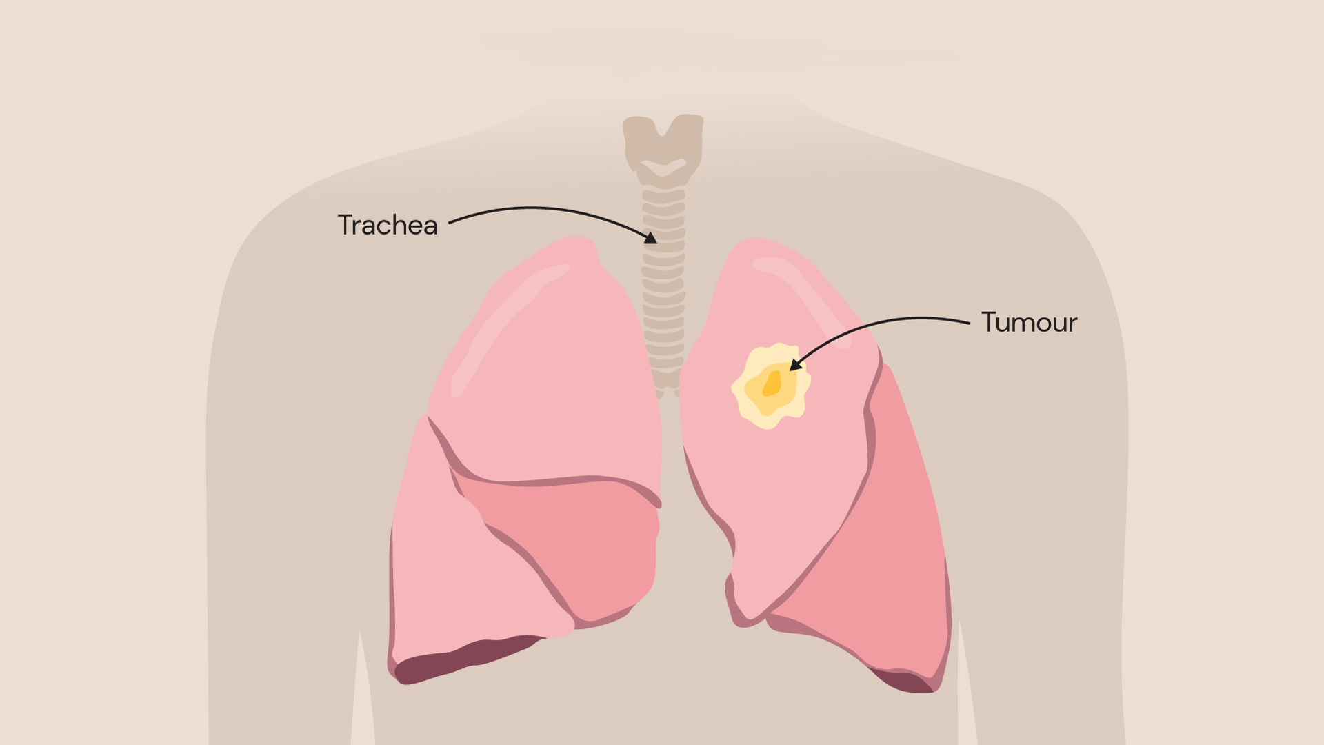 An illustration showing lung cancer occurs when cells become abnormal and form into a lump called a tumour.