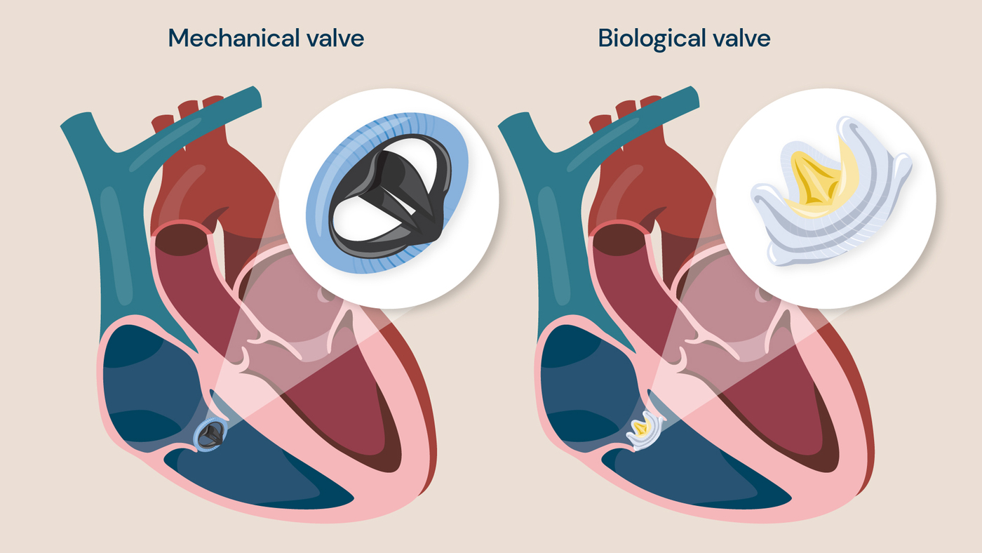 Illustration comparing mechanical and biological heart valve replacements shown within the heart.