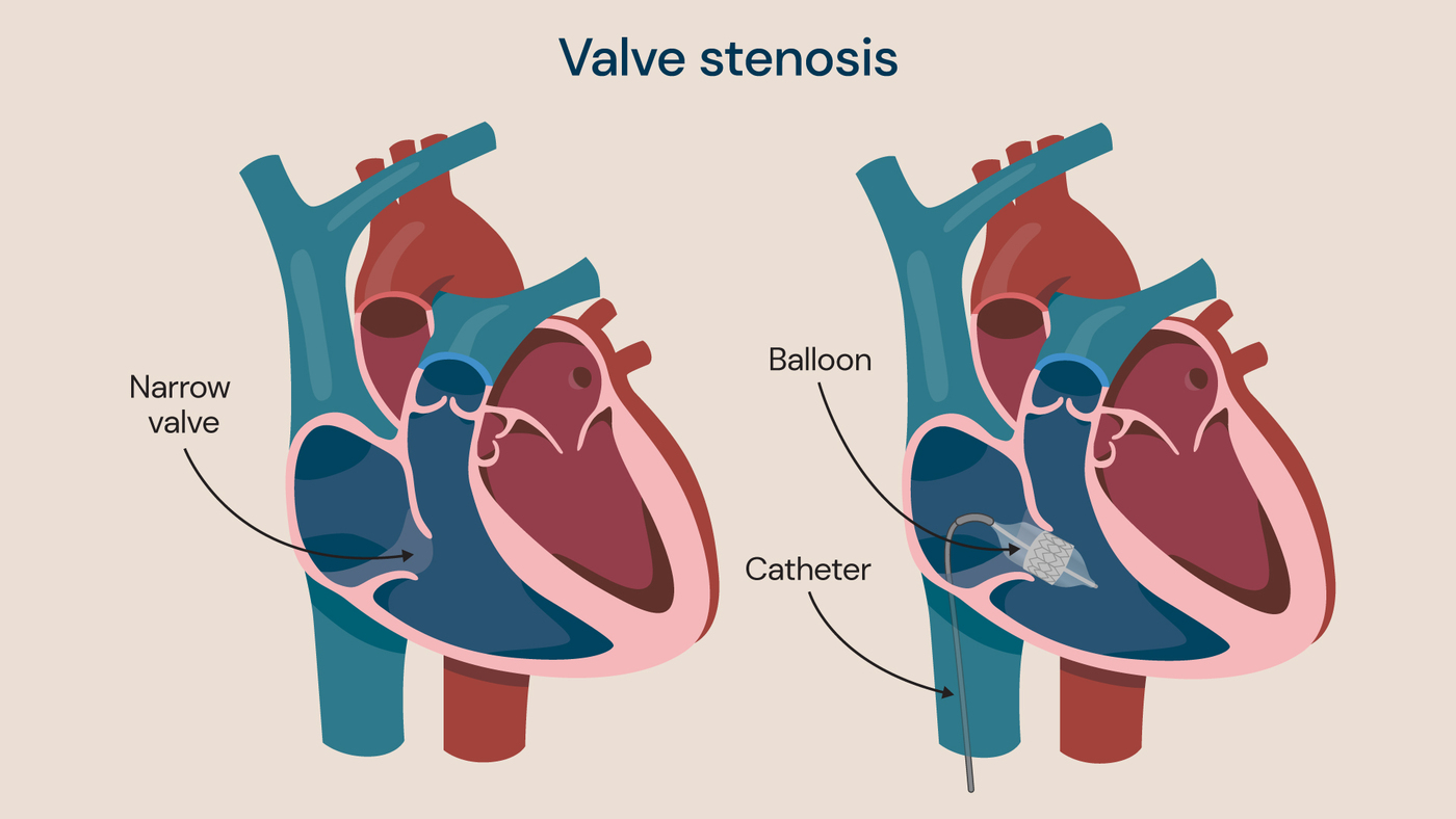 Medical illustration showing heart valve stenosis with a narrowed valve and a catheter balloon used to widen the valve.