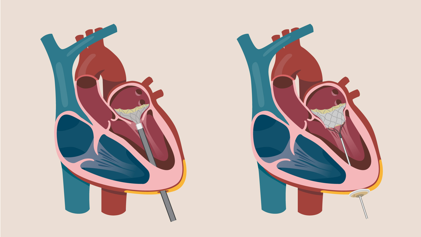 Medical illustration showing the Tendyne transcatheter mitral valve replacement positioned inside the heart to replace the mitral valve.