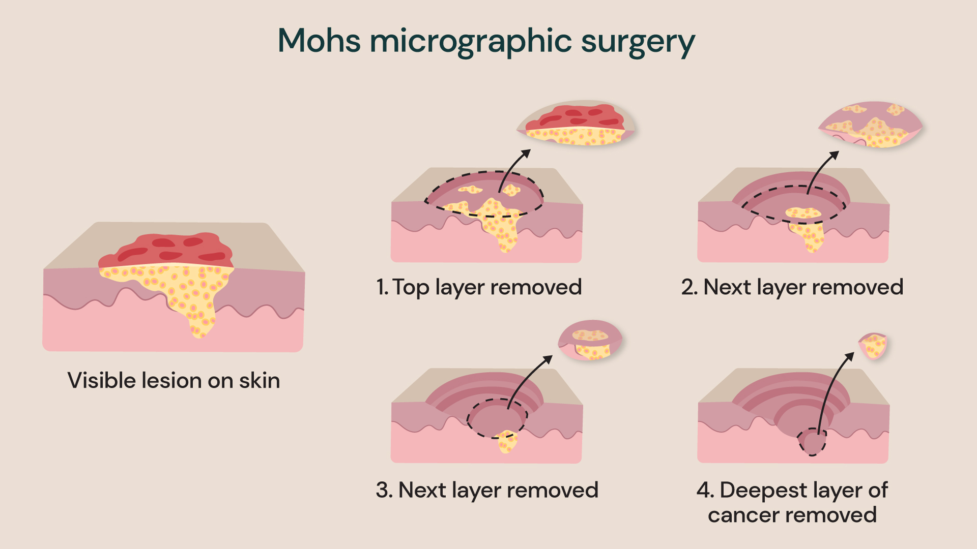 Illustrated diagram showing Mohs micrographic surgery with layers of skin removed in stages until all cancer cells are cleared.