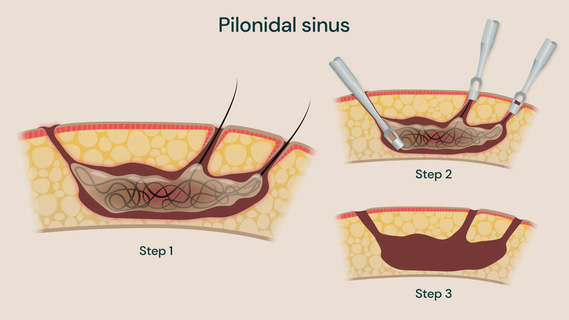 Medical illustration of a pilonidal sinus in the skin near the buttock cleft, showing a hair-filled sinus cavity beneath the skin and three stages of treatment including incision, removal of hair and debris, and closure of the wound.