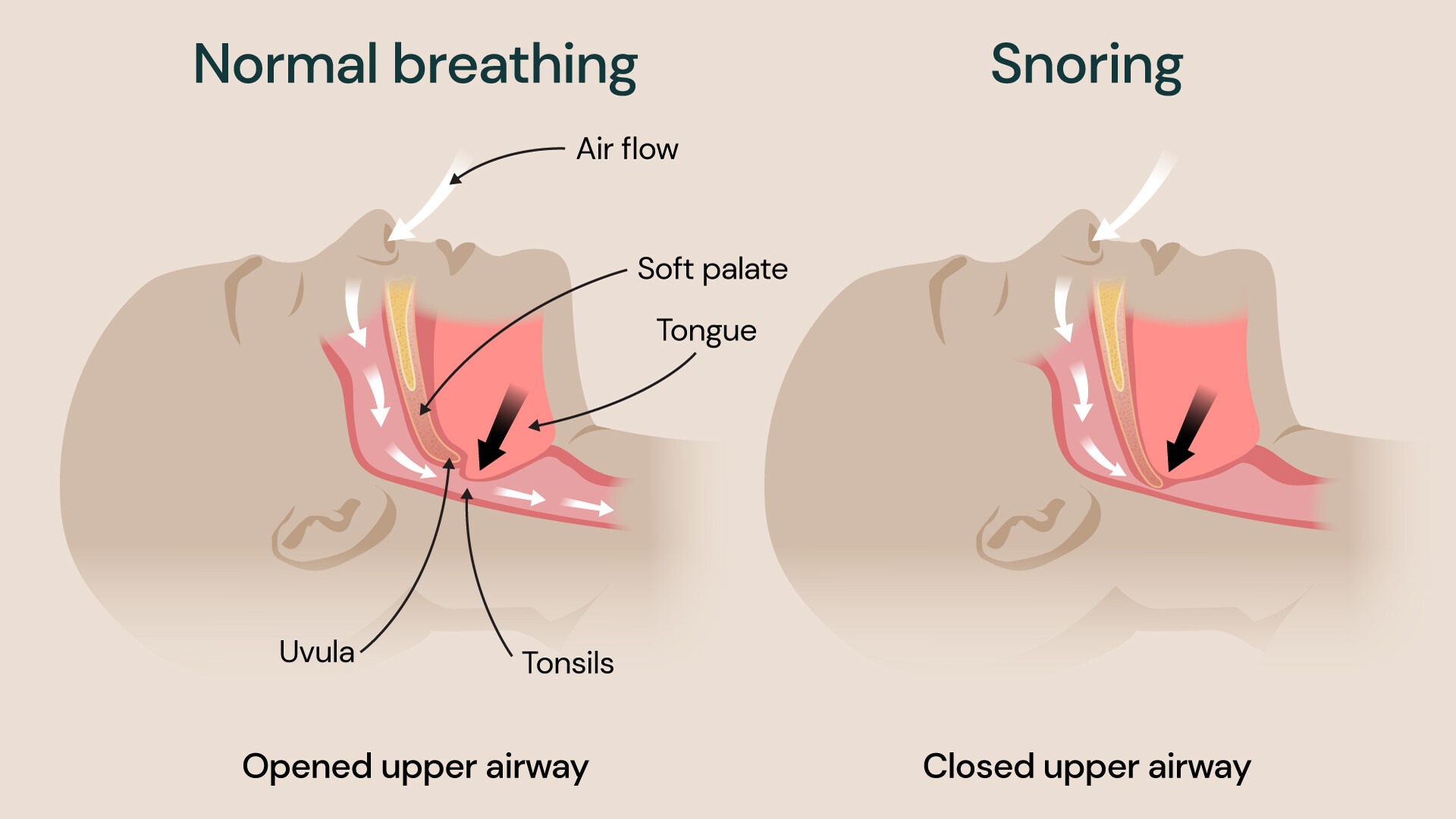 Causes of snoring