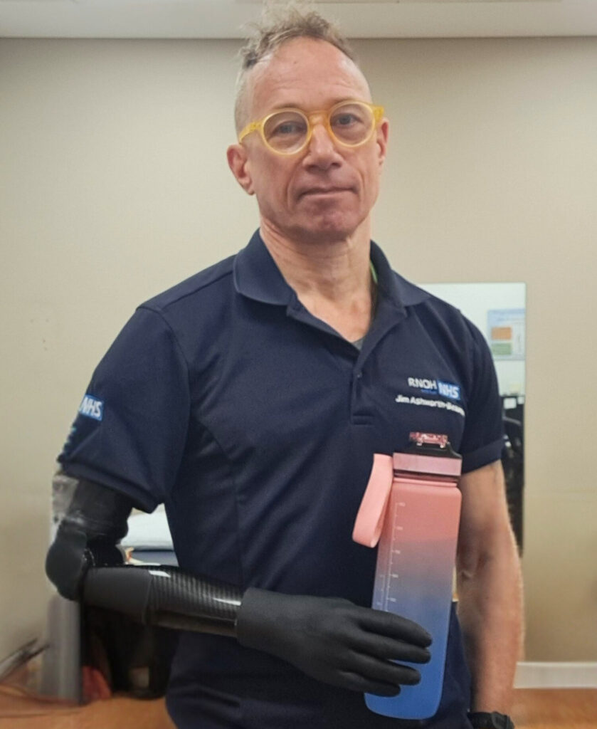 A man wearing a blue top, showcasing a prosthetic arm attached to his bone through osseointegration surgery.