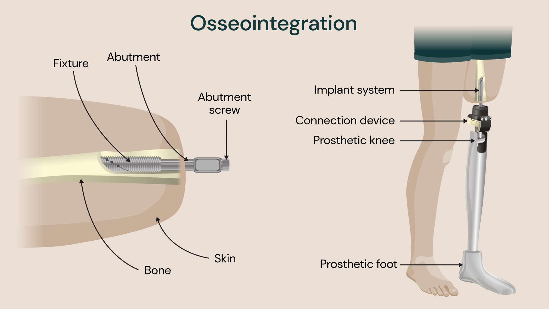 Labelled diagram of a knee joint, detailing its components relevant to surgical procedures for prosthetic limb attachment with osseointegration.