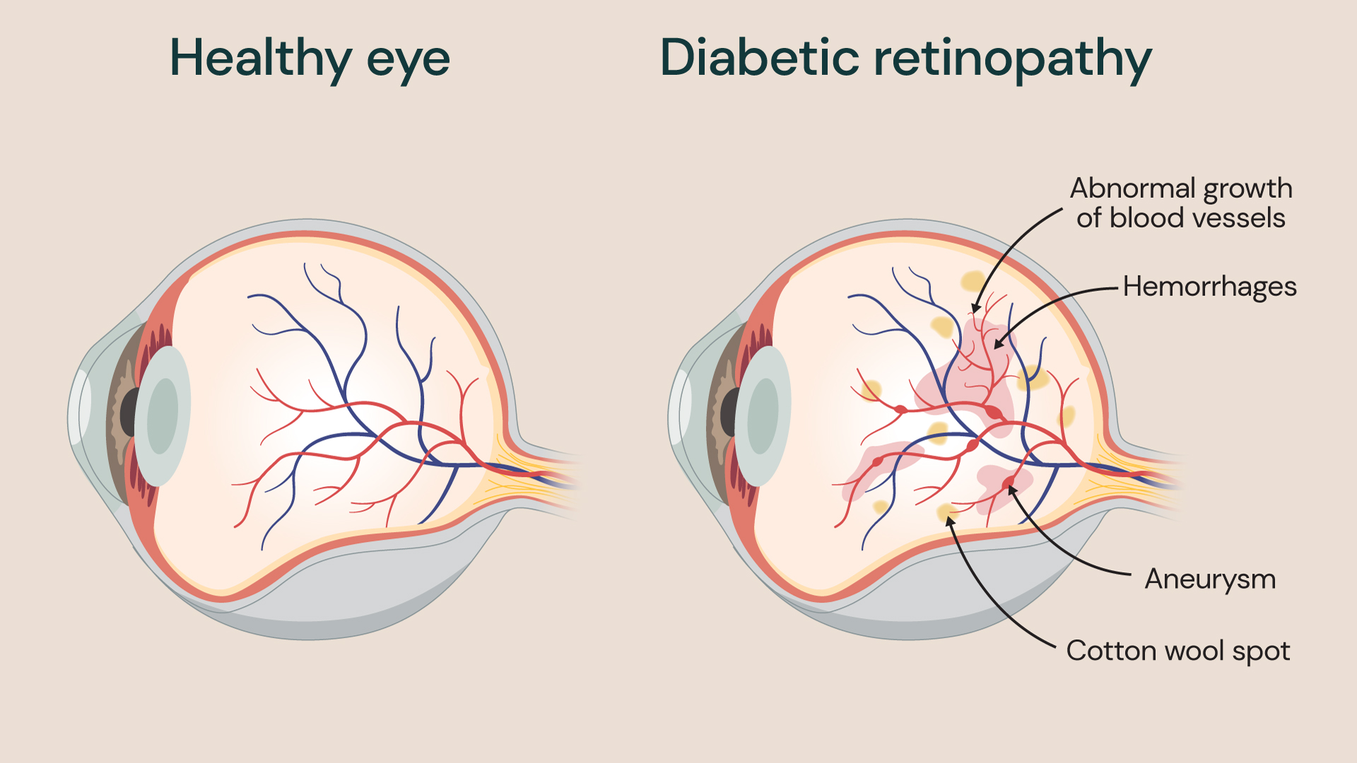 Illustration of normal eye and the eye of someone with diabetic retinopathy