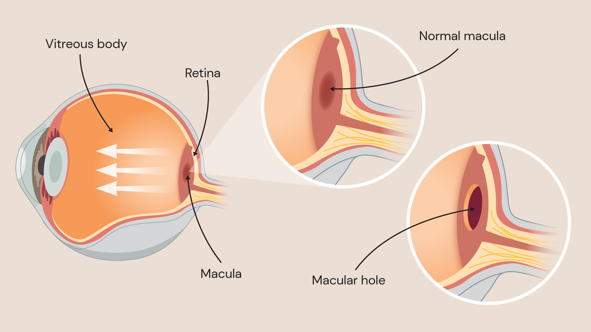 Medical illustration of the eye showing the vitreous body, retina and macula, with inset diagrams comparing a normal macula and a macular hole affecting the centre of the retina.