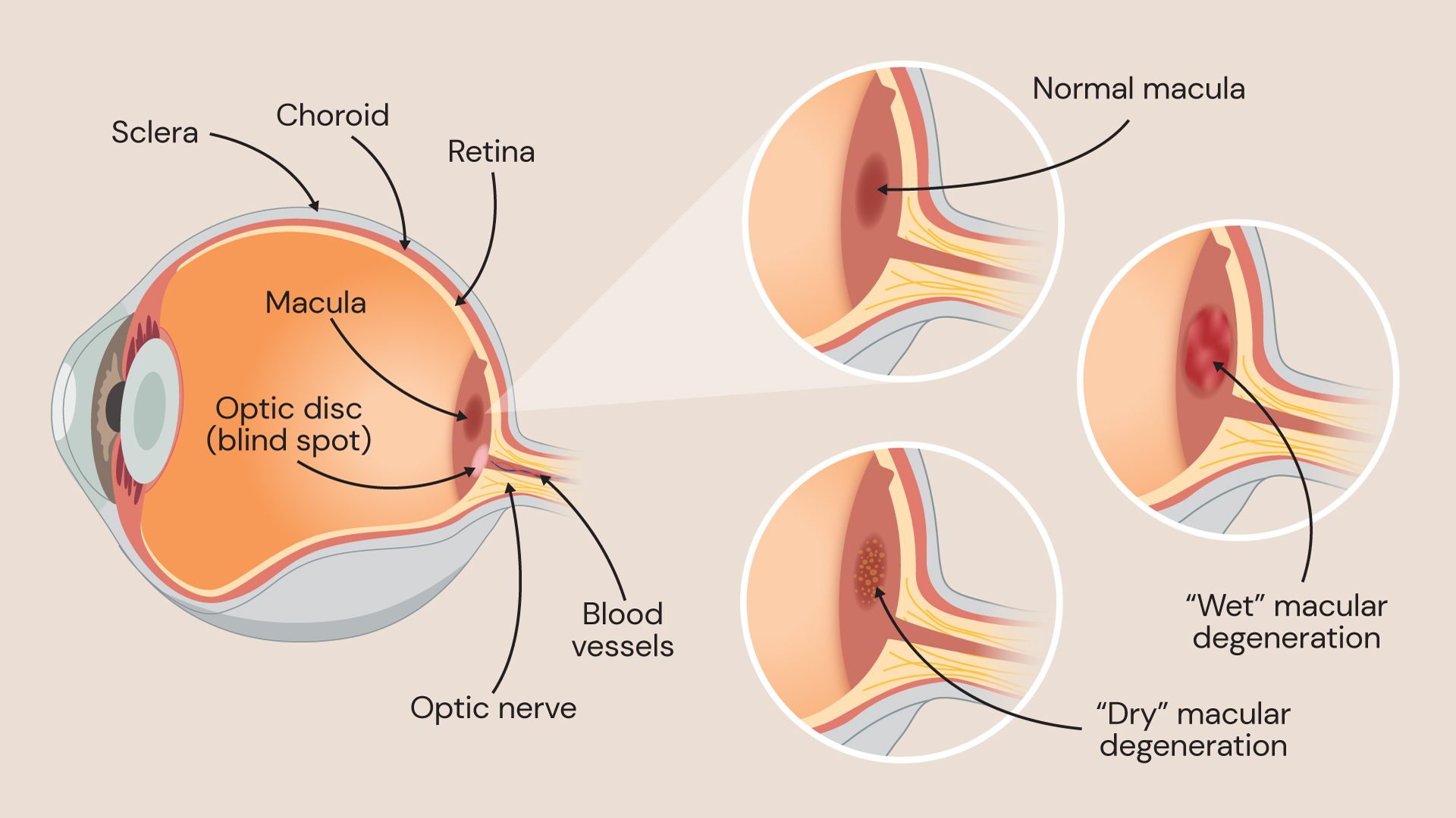 Medical illustration of the eye showing the retina, macula, optic nerve and optic disc, with comparison of a normal macula and changes seen in wet and dry macular degeneration
